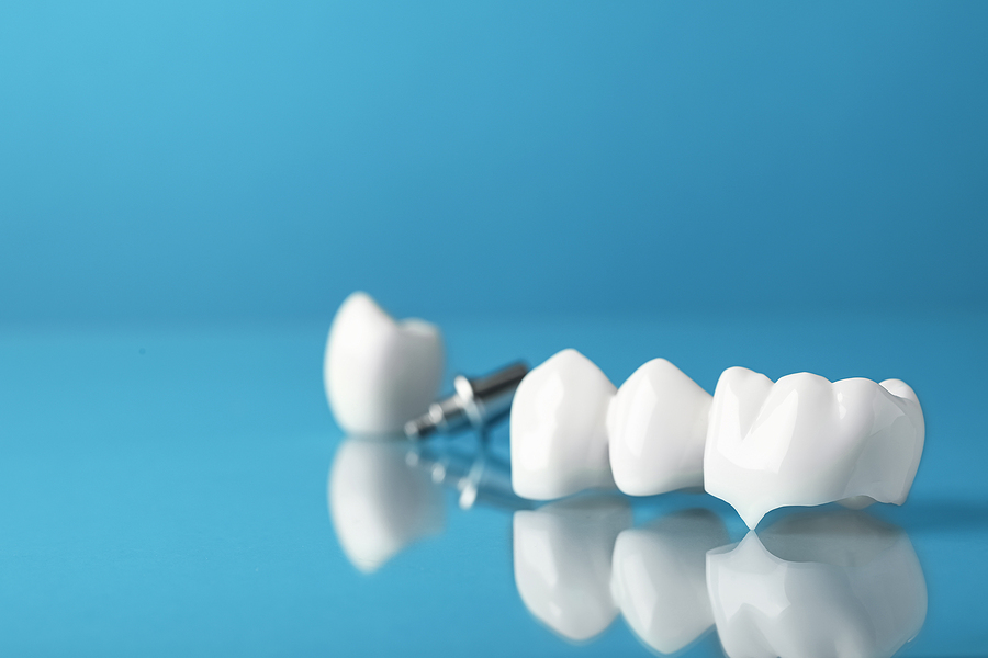 The Dental Crown Process