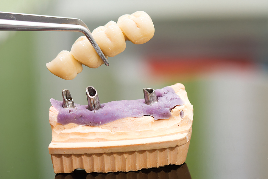 How to Maintain Proper Oral Hygiene When You Have Dental Implants – Tips and Tricks