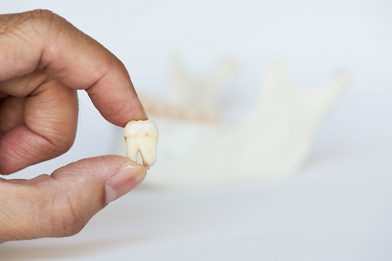 Do You Need A Tooth Extraction?