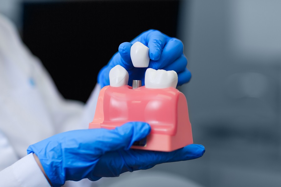 All about Dental Implants