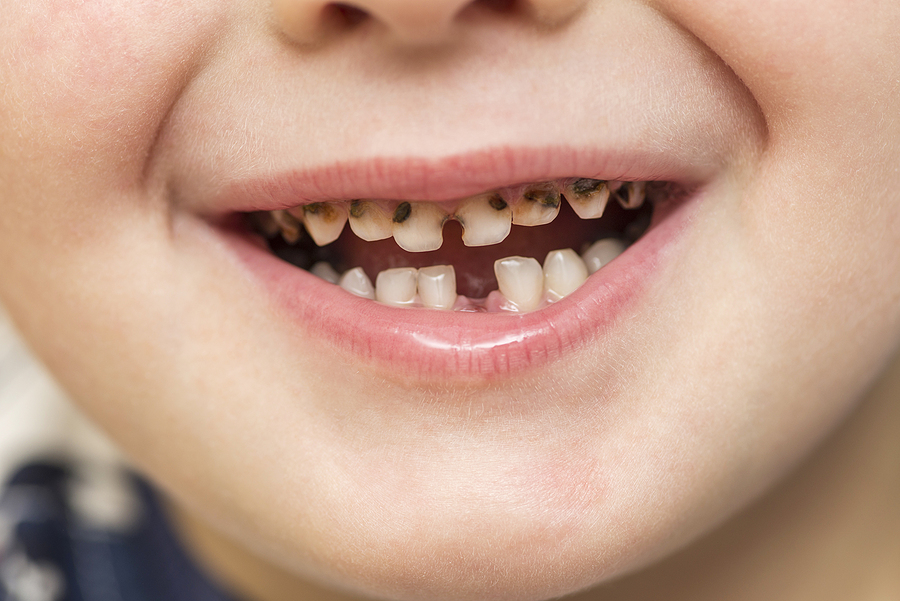 Common Dental Problems in Children