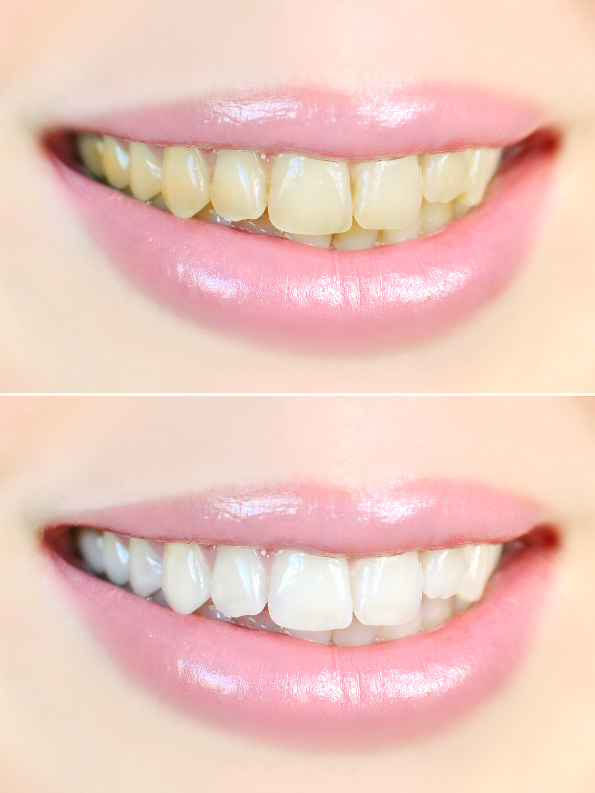 How to Brighten the Teeth?